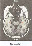 Brain Injury MRI of Depression