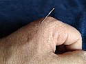An acupuncture needle injected into my hand