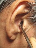 耳の指圧棒の位置