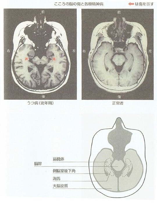 うつ病、脳の傷、扁桃体の欠損MRI図ジ