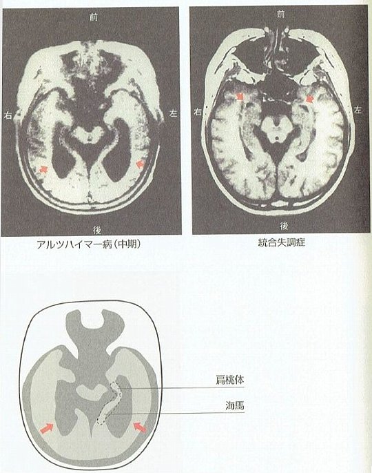 統合失調症、脳の傷、扁桃体の欠損MRI図ジ