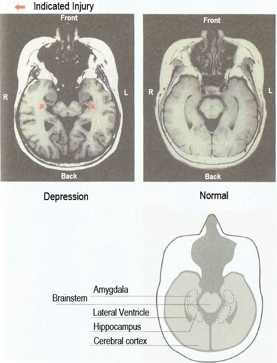 Figure 2: Depression Brain Injury MRI Excerpt from the book “Mental Illness is a Brain Injury” with the permission of the author, Mr. Takumi Tanabe.