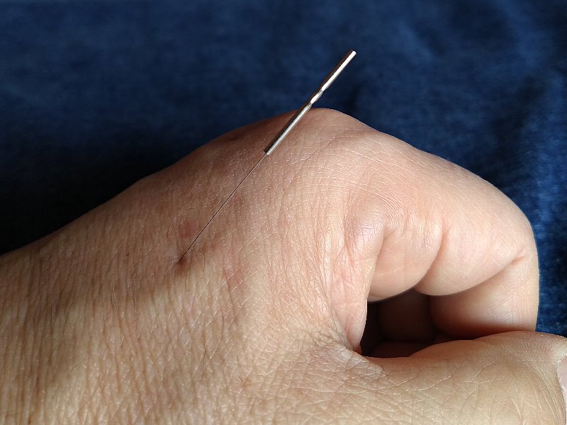 Fig.1 An acupuncture needle injected into my hand