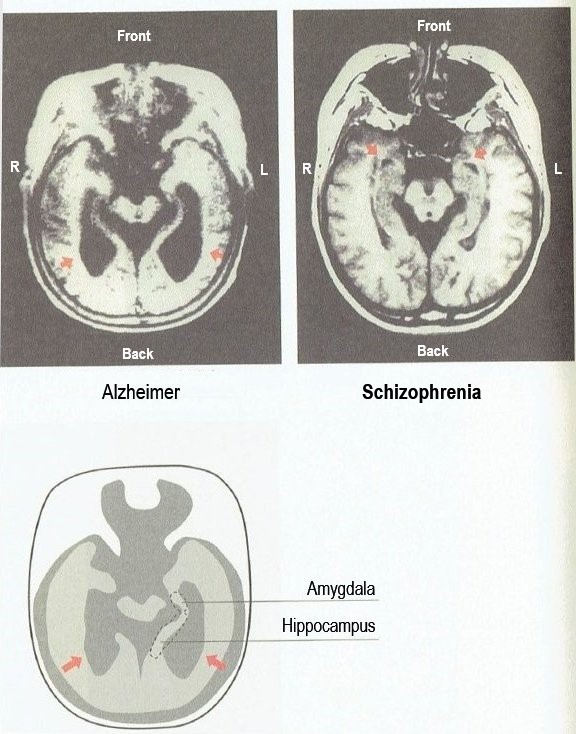  Figure2: Brain Injury MRI of Alzheimer and Schizophrenia