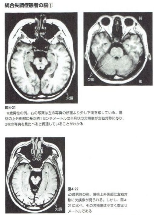 統合失調症の脳の扁桃体の傷　MRI図